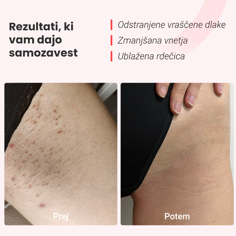 Fotoepilator IPL Hilda